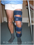 Post ACL reconstruction with a knee brace