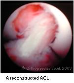 A reconstructed anterior cruciate ligament