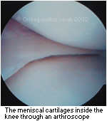 Meniscal cartlages inside the knee