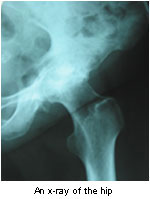 Hip x-ray