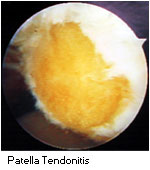 Patella tendonitis