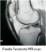 MRI scan of patella tendonitis
