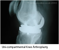X-ray of a Uni-compartmental knee arthroplasty
